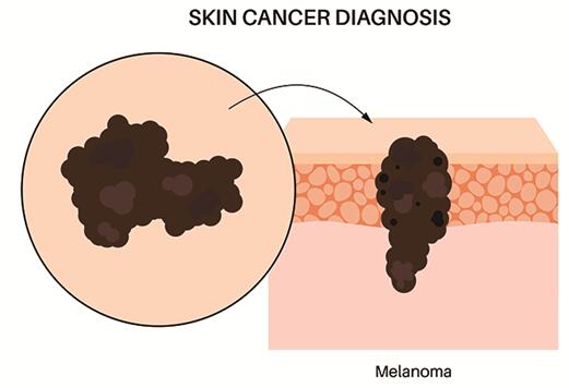 Melanoma Organoids