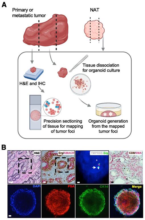 Establishment workflow of Prostate Cancer Organoids